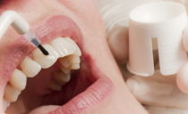 Métodos e etapas da fluoretação dentária, fluoretação do esmalte em casa