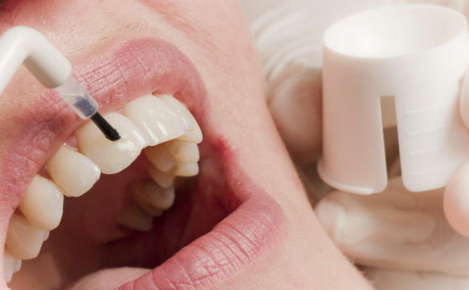 Métodos y etapas de fluoración dental, fluoración del esmalte en el hogar.