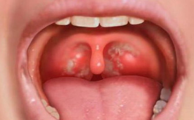 Titik putih pada tonsil dan tonsil di tekak pada kanak-kanak dan orang dewasa: penyebab dan rawatan