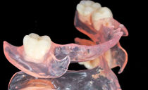 Răng giả thế hệ mới không có vòm miệng với sự vắng mặt hoàn toàn và một phần của răng