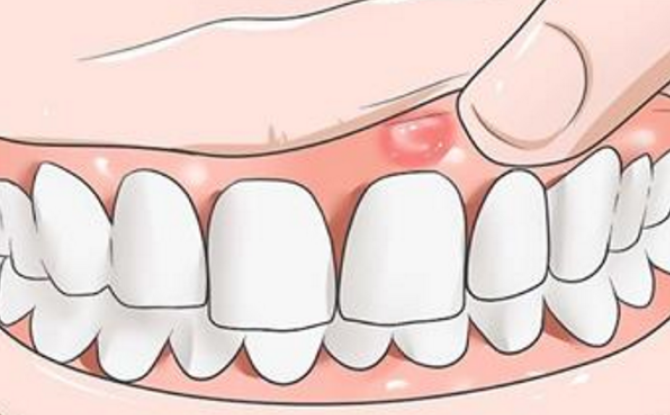 Symptomer og behandling af betændelse i tandens periosteum
