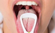 المبيضات التهاب الفم: الأسباب والأعراض والمخدرات والعلاج البديل