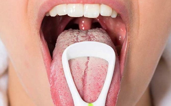 Viêm miệng do nấm Candida: nguyên nhân, triệu chứng, thuốc và phương pháp điều trị thay thế