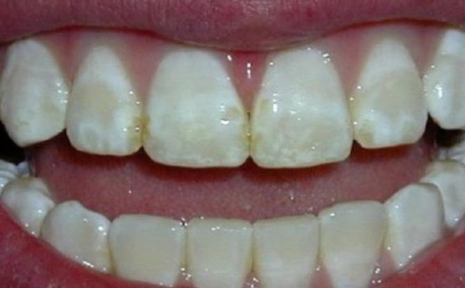 Dental fluorose hos børn og voksne: symptomer, behandling, emaljeblegningsmetoder, forebyggelse