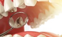 The causes and stages of development of dental caries