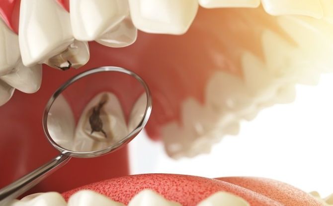 As causas e estágios do desenvolvimento da cárie dentária