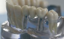 Types of dental bridges, which are better, how to put and how much they cost