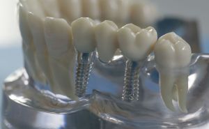Tipi di ponti dentali, che sono migliori, come mettere e quanto costano