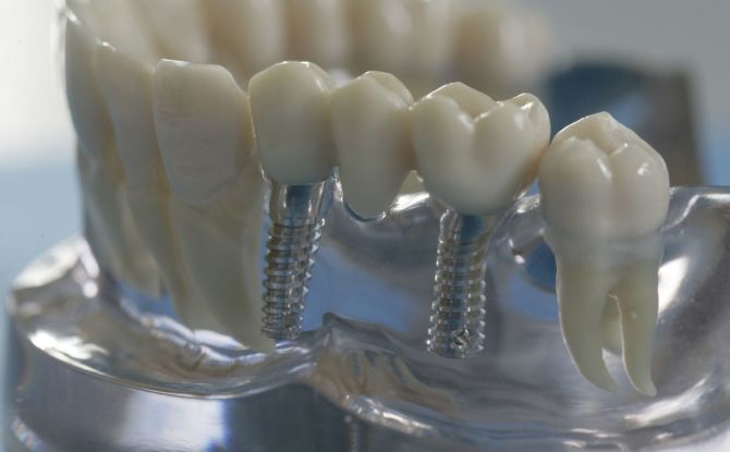 Vrste zubnih mostova, koji su bolji, kako staviti i koliko koštaju