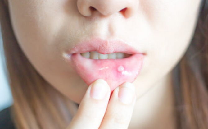 Inflamación de la mucosa oral: causas y tratamiento.