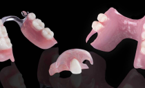 ฟันปลอมที่ถอดออกได้และไม่สามารถถอดออกได้โดยไม่มีฟันบางส่วน: ชนิดและภาพถ่าย