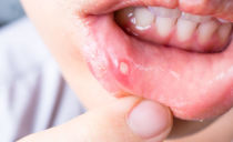 التهاب الفم: الأعراض والأسباب والعلاج والوقاية