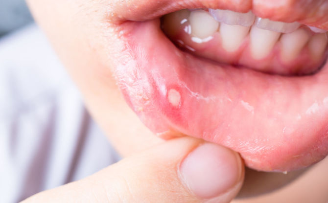 التهاب الفم: الأعراض والأسباب والعلاج والوقاية