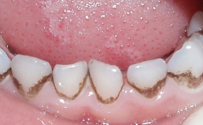 Pourquoi les dents noircissent à l'intérieur et à l'extérieur des adultes et des enfants, que faire