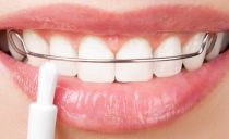 Zadržovače zubů po rovnátkách: proč jsou potřeba, jak jsou nainstalovány a kolik