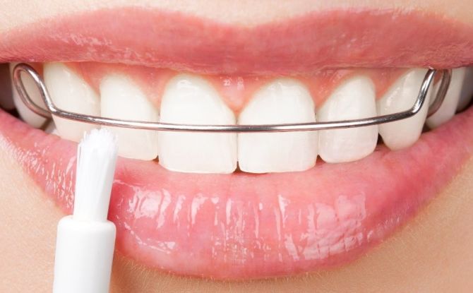 Фиксатори за зъби след брекети: защо са необходими, как се инсталират и колко