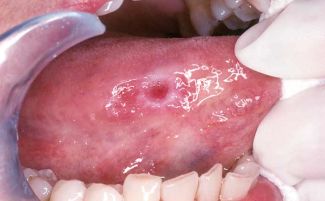 Úlcera de lengua