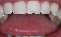 Lustai ant dantų: kodėl dantys lūžta, ką daryti, gydymo metodai