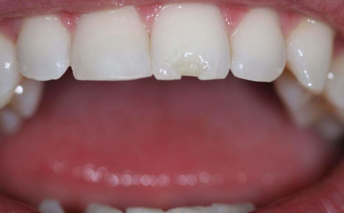 שבבים בשיניים: מדוע שיניים מתפרקות, מה לעשות, שיטות טיפול