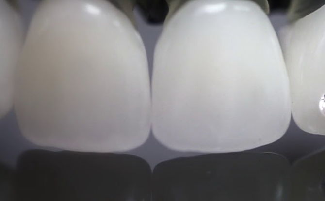 זנים והתקנת קישוטים לשיניים: שמיים, אבני חן, יהלומים ואחרים