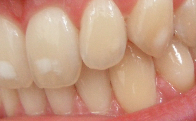Hvide pletter på tænder hos voksne og børn: hvorfor de vises, og hvordan man slipper af