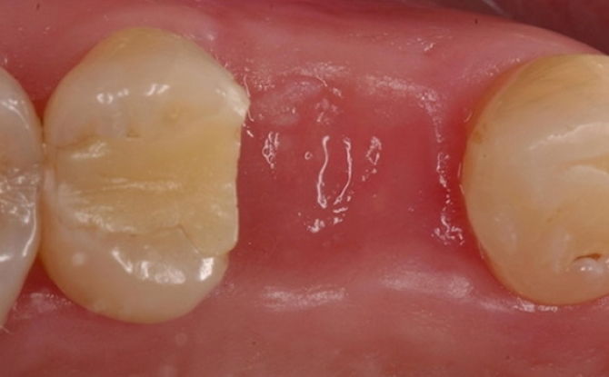 Vit plack i hålet efter tanduttag: foton, orsaker och behandling