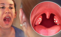 White lumps in the throat on the glands and tonsils: what is it and how is it treated