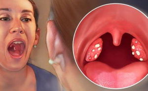 White lumps in the throat on the glands and tonsils: what is it and how is it treated