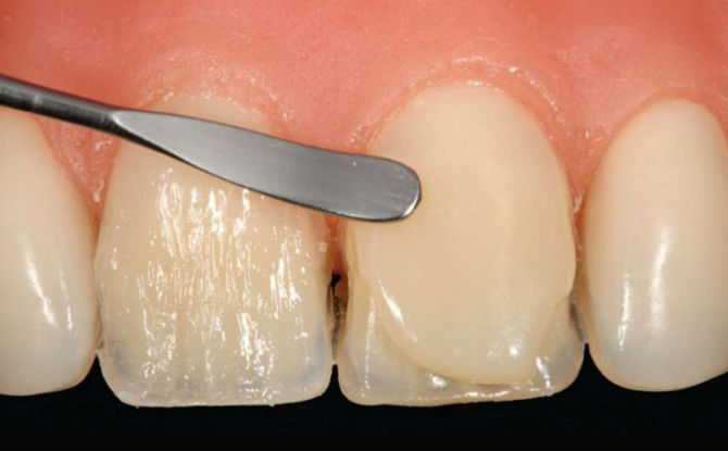 Direct composite veneers: what is it, installation, indications and photos