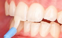 Restaurering av tannemaljen: i tannbehandling, hjemme