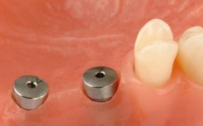 „Implant Gum Shaper“: kas tai yra, kaip jis sumontuotas