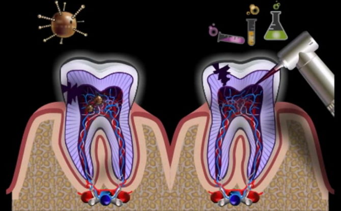 Infiammazione della radice del dente e dei canali dentali: segni, sintomi e trattamento