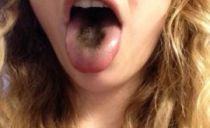 Black coating on the tongue: types, causes, diagnostics