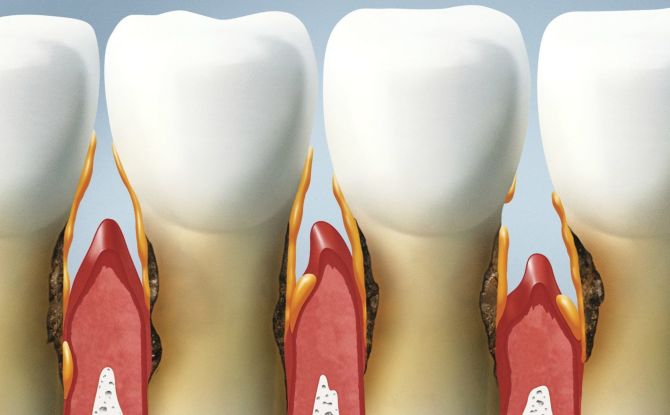 Punca, simptom dan rawatan periodontitis