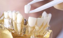 Làm thế nào để đặt mão lên răng: các giai đoạn và quy trình cài đặt, chuẩn bị răng, có đau không khi đặt