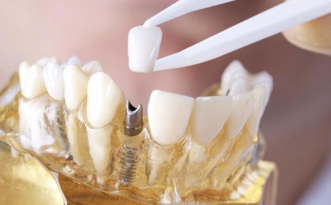 איך לשים כתר על שן: שלבים ותהליך התקנה, הכנת שיניים, האם כואב לשים