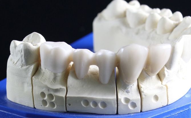 Typer och kostnader för falska tänder, vilket är bättre, hur man sparar