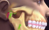 Dislocación de la mandíbula inferior: síntomas, tratamiento, cómo enderezar la mandíbula en casa