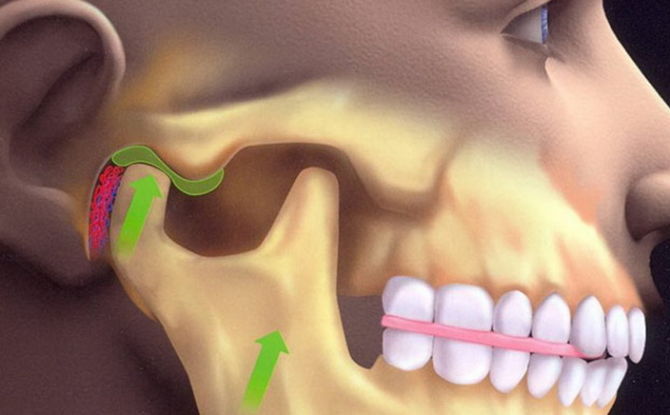 Dislokacija donje čeljusti: simptomi, liječenje, kako ispraviti čeljust kod kuće