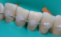 Stropirea dinților mobili în stomatologie: ce este, metode pentru boala parodontală și parodontită