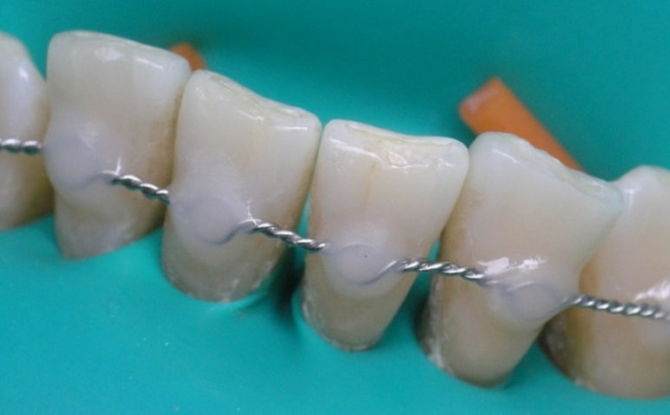 Attelle des dents mobiles en dentisterie: qu'est-ce que c'est, méthodes pour les maladies parodontales et la parodontite