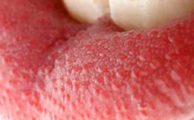 דלקת של הפפילות בשורש ובקצה הלשון, גורמים להגדלה (היפרטרופיה)