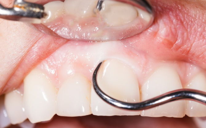 Apakah penyusunan poket periodontal, kaedah curettage