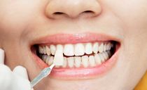 Cosa sono le faccette sui denti: tipi, vantaggi e svantaggi