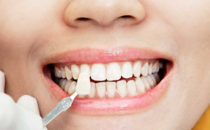 Apakah veneers pada gigi: jenis, kelebihan dan kekurangan