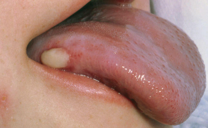 Zungenkrebs: Wie erkennt man die Krankheit in einem frühen Stadium, Arten, Ursachen, Symptome, Behandlung