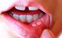 Causes, symptoms and treatment of aphthous stomatitis