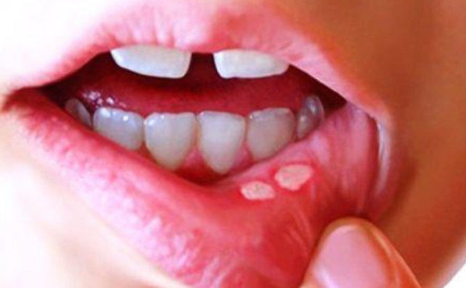 أسباب وأعراض وعلاج التهاب الفم القلاعي
