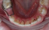 Placca Priestley su denti da latte in un bambino: cause, trattamento, prevenzione