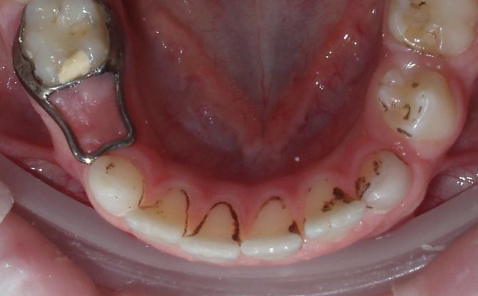 Plak Priestley pada gigi bayi pada kanak-kanak: penyebab, rawatan, pencegahan